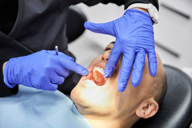 Best Emergency Wisdom Tooth Extraction in Ogdensburg, NY